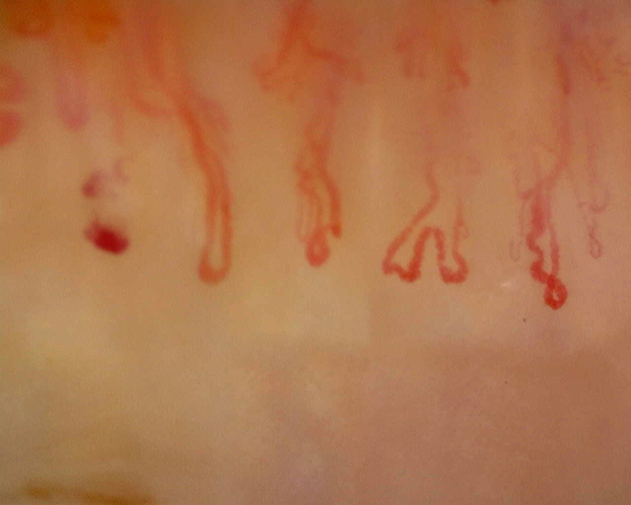 Nailfold capillaroscopy: right ring finger, field b. Late SSc Cutolo Pattern: Representative Case.