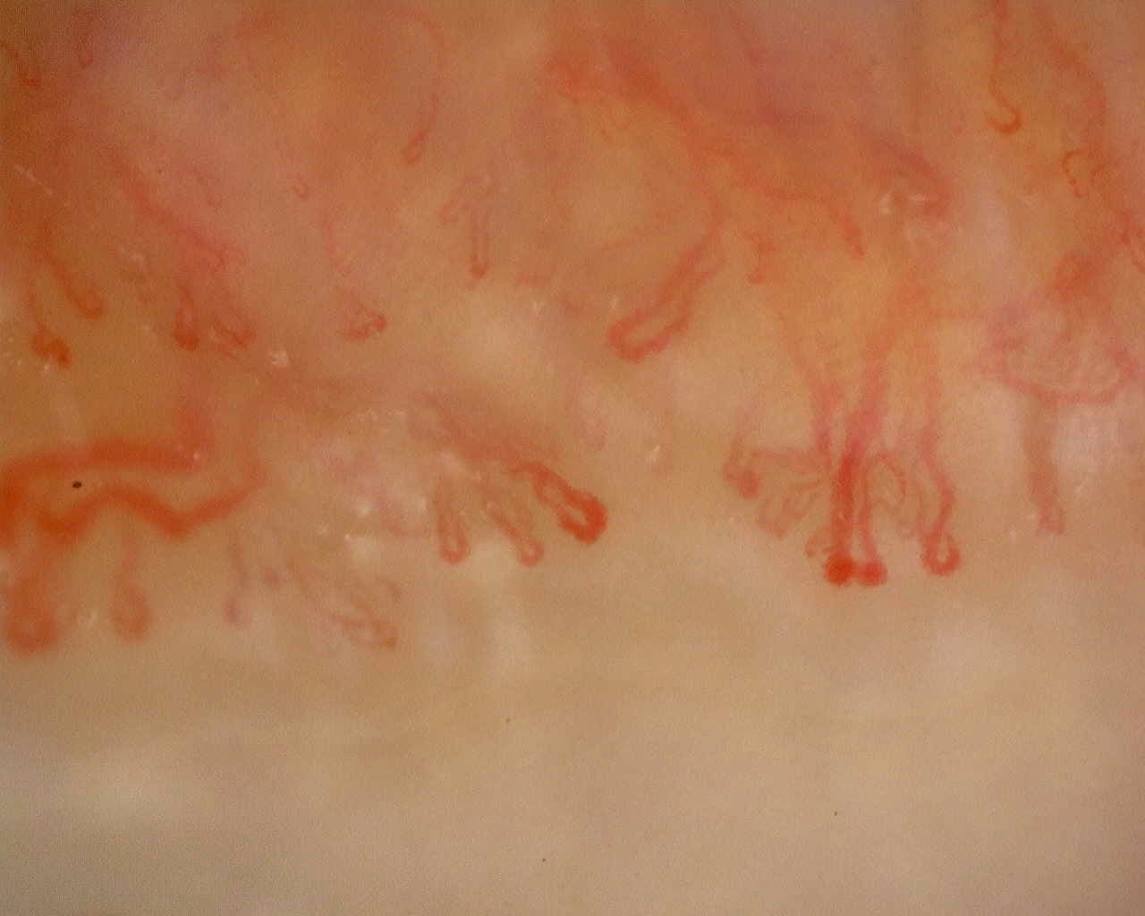 Nailfold capillaroscopy: right little finger, field c. Late SSc Cutolo Pattern: Representative Case.